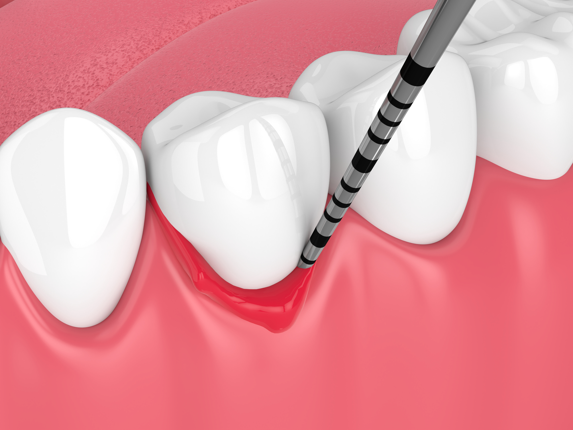 Dental Scaling Treatment
